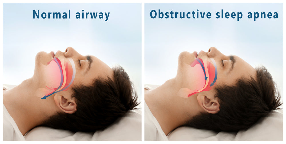 CAUSES AND SYMPTOMS OF OBSTRUCTIVE SLEEP APNEA