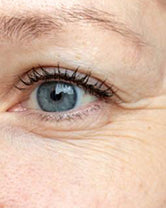 Before — Krista J., 55 · Denver, CO